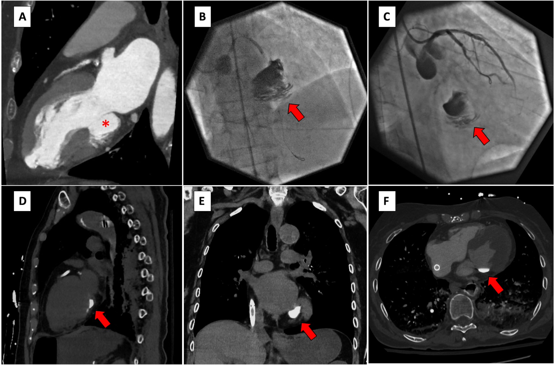 Figure. (A) Pre-existing inferior left ventricular aneurysm