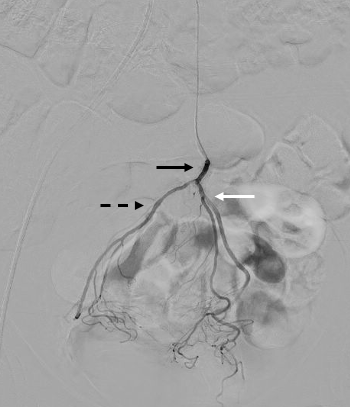Figure 2. Selective angiography with digital subtraction in superselective arterial phase of the superior rectal artery (black arrow) and its right (black dashed arrow) and left branches (white arrow).