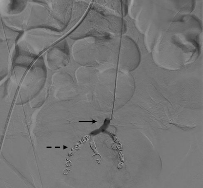 Figure 3. Angiography with digital subtraction of the superior rectal artery (black arrow) in the immediate post-embolization period showing occlusion with microcoils of the branches of the superior rectal artery (black dashed arrow).