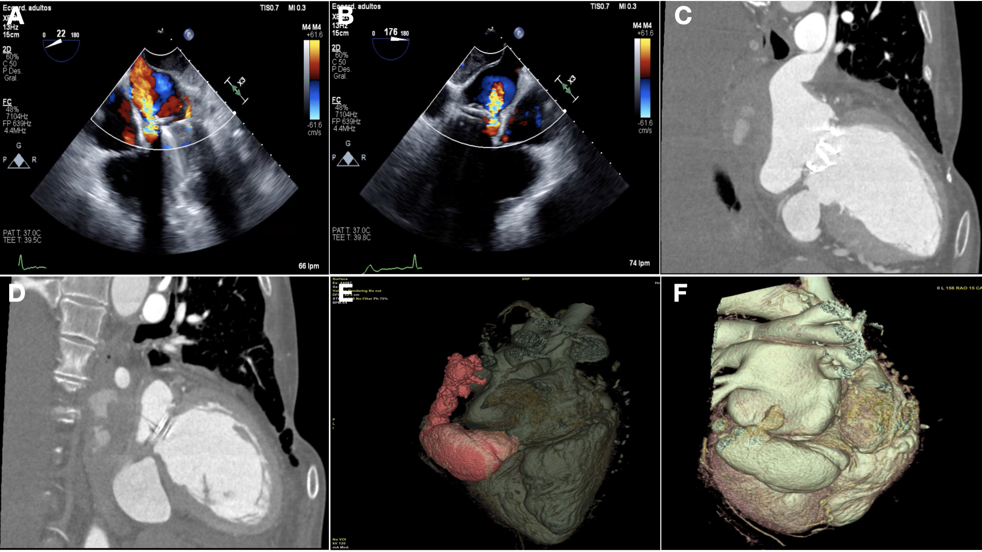 Figure 1. (A, B) Transesophageal echocardiogram. (C-F) Computed tomography scan.