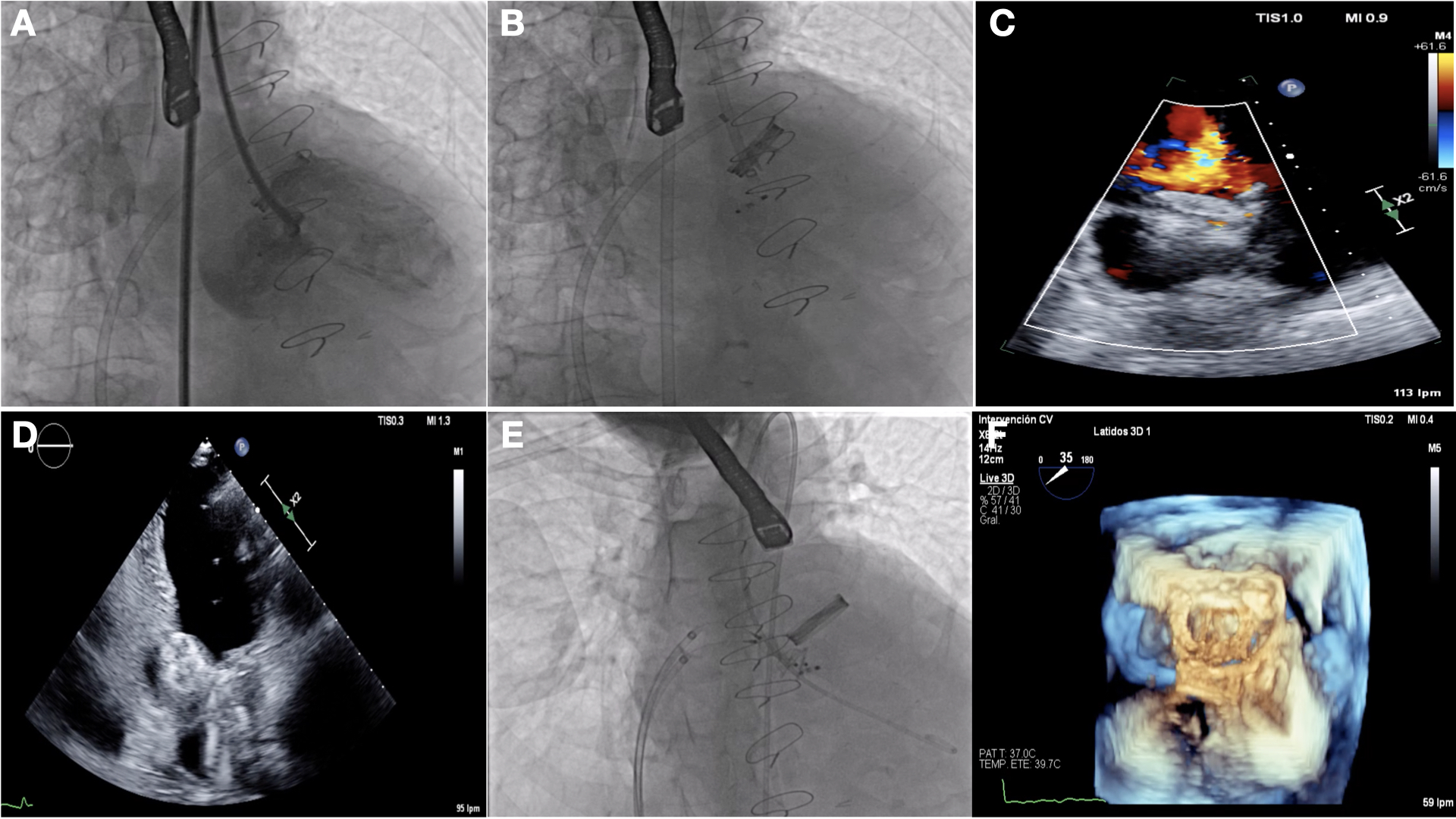 Figure 2. (A-D) Percutanous closure of pseudoaneurysm.