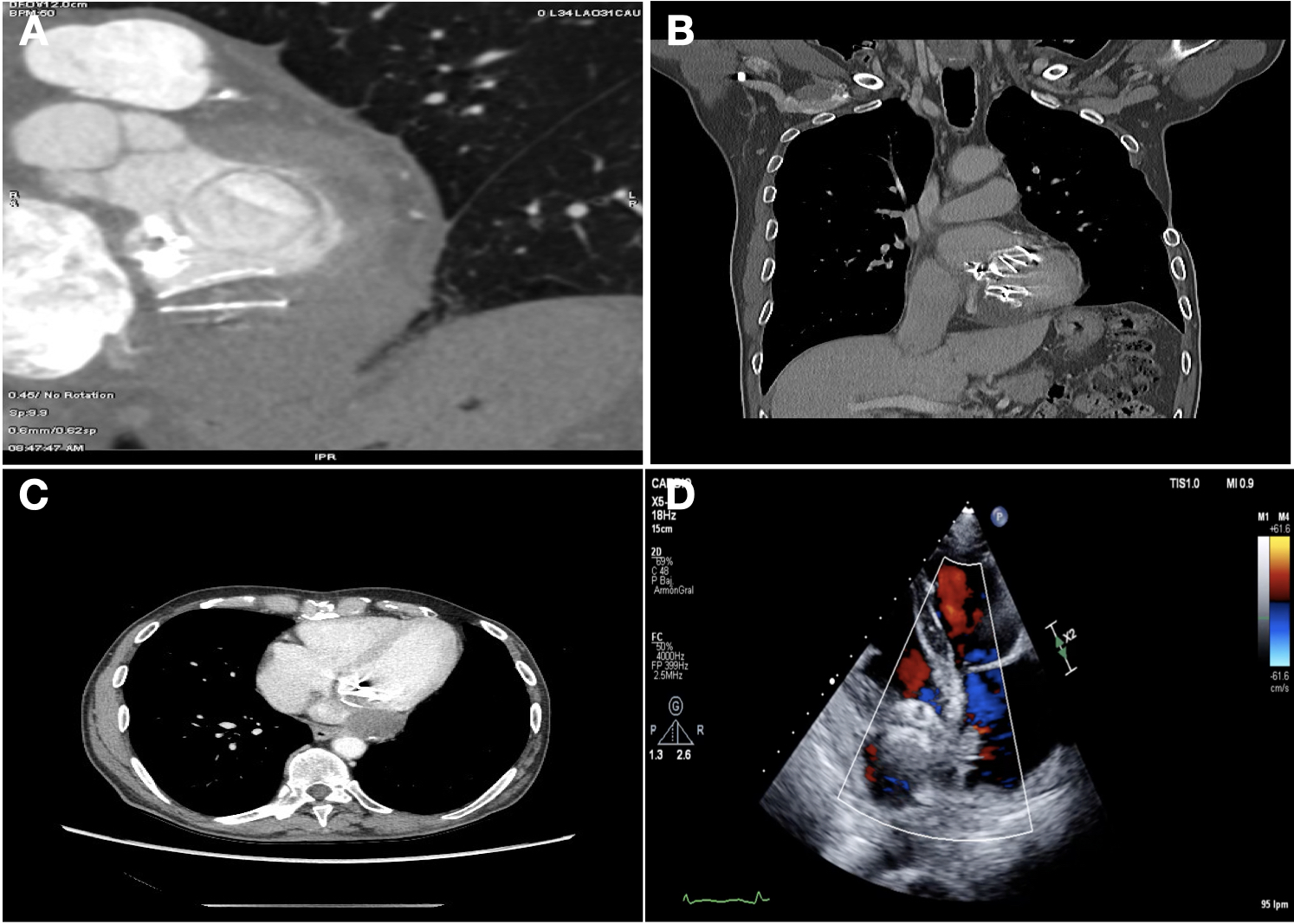 Figure 3. (A-D) Following-up computed tomography and transesophageal echocardiogram.