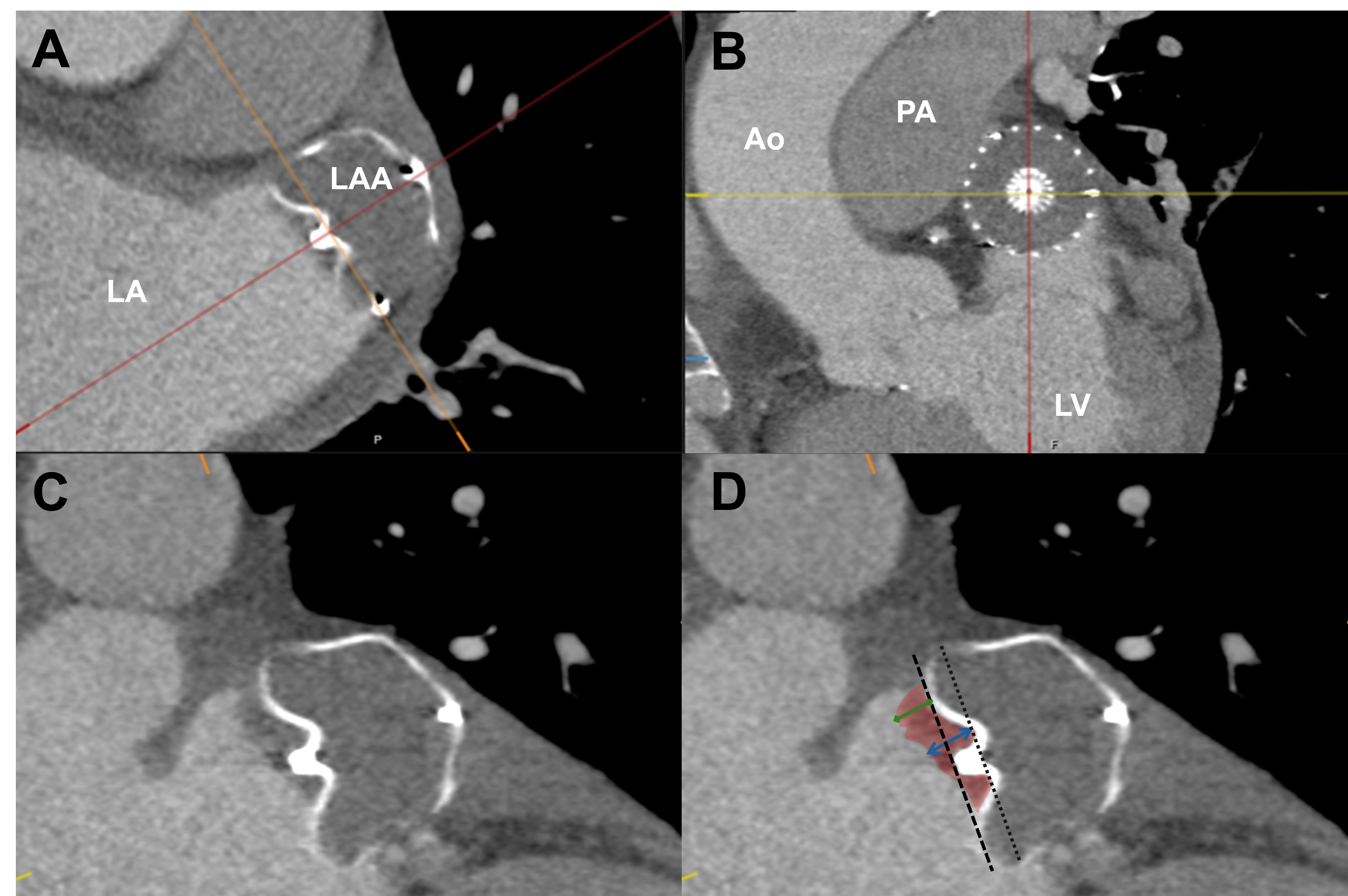 Figure 1. Cardiac CT measurements