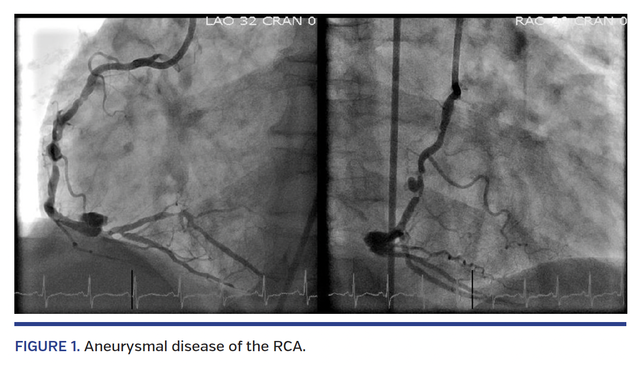 FIGURE 1. Aneurysmal disease of the RCA.