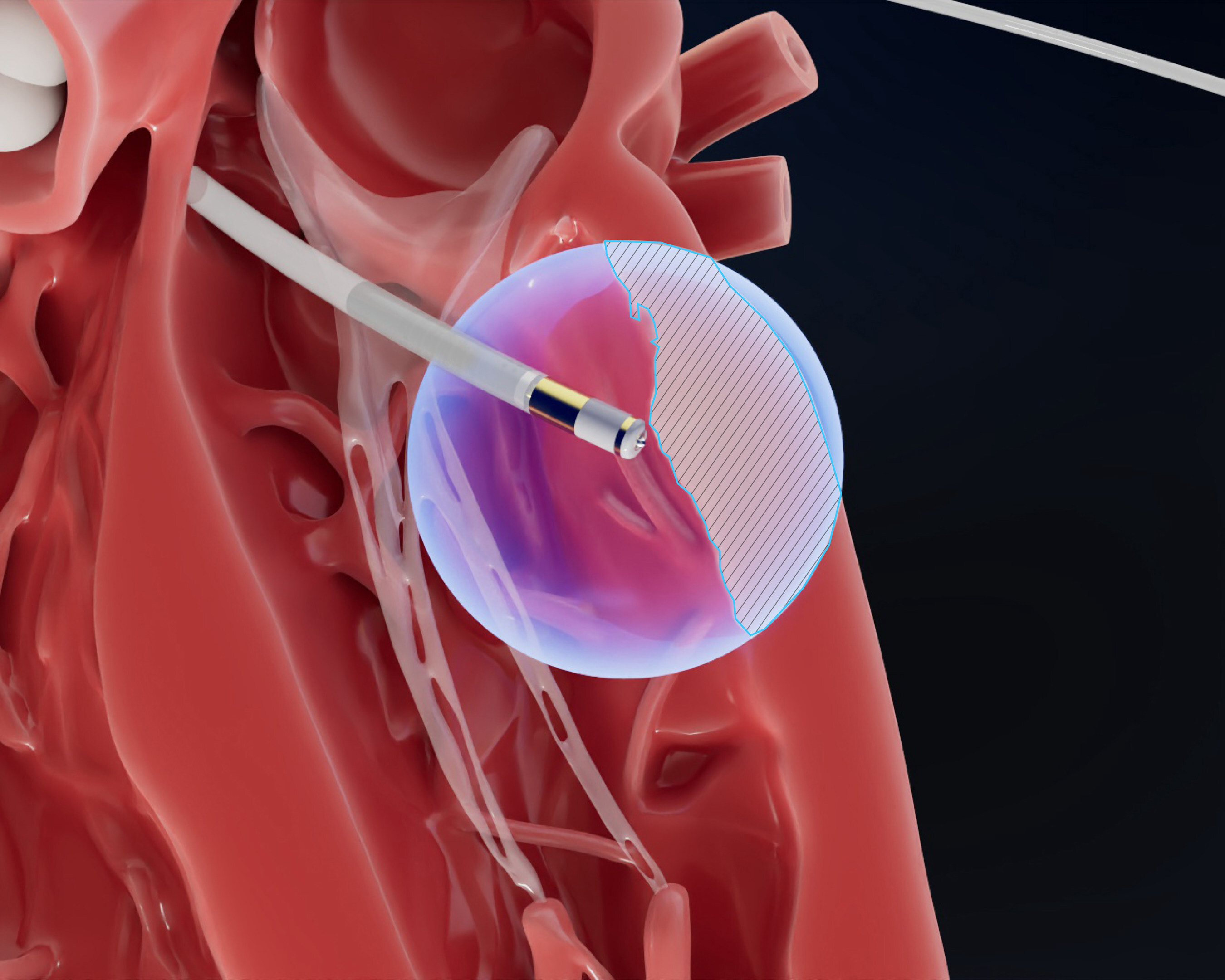 Field Medical: Engineered to reach the epicardium from the endocardium, the FieldForce™ Ablation System catheter is designed to enable focal pulsed field ablation for full-thickness, transmural lesions.