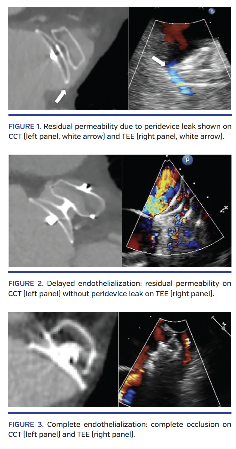 Residual Permeability After LAA Closure
