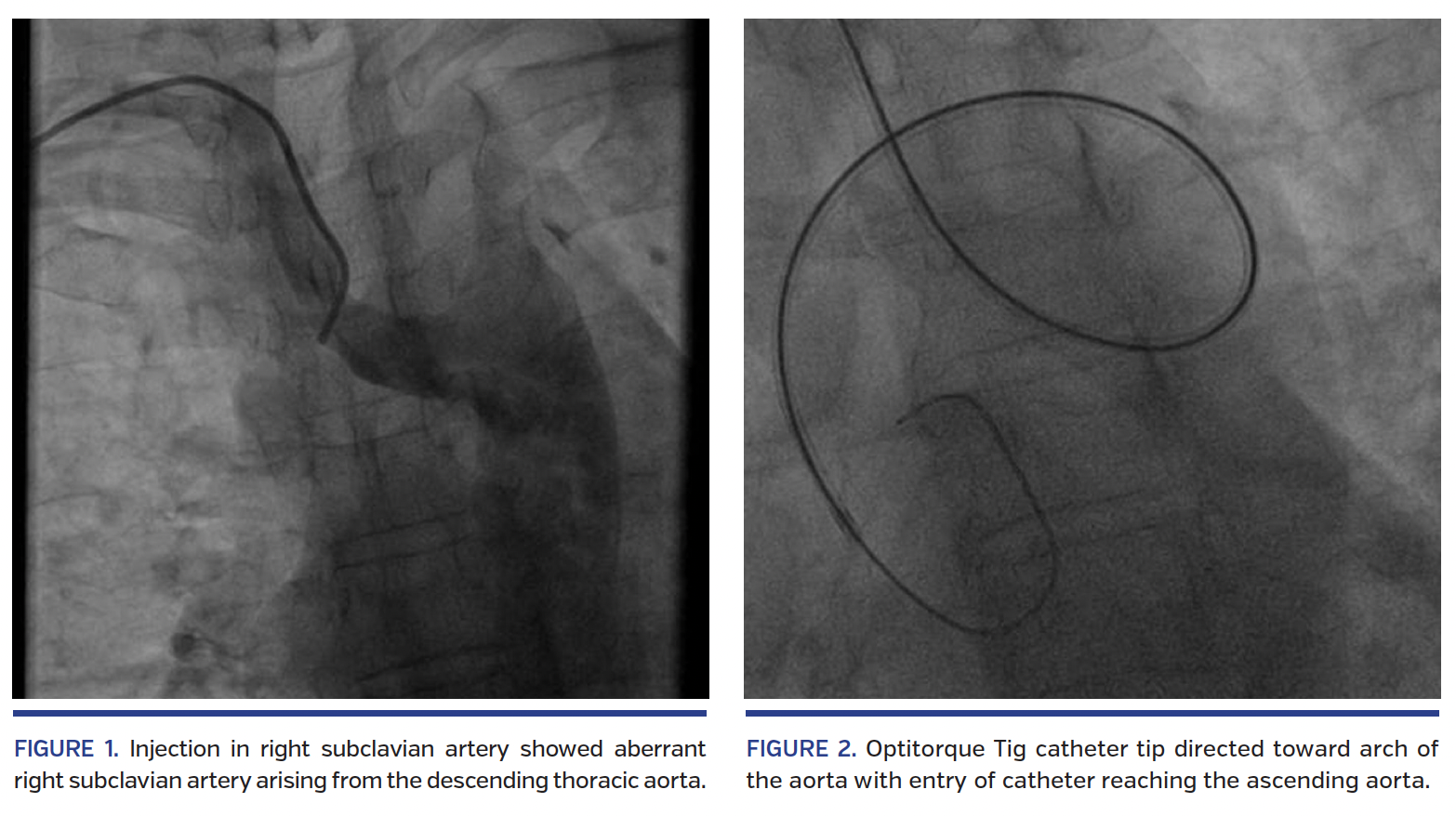 Incidental Detection of Arteria Lusoria During Transradial Coronary Intervention