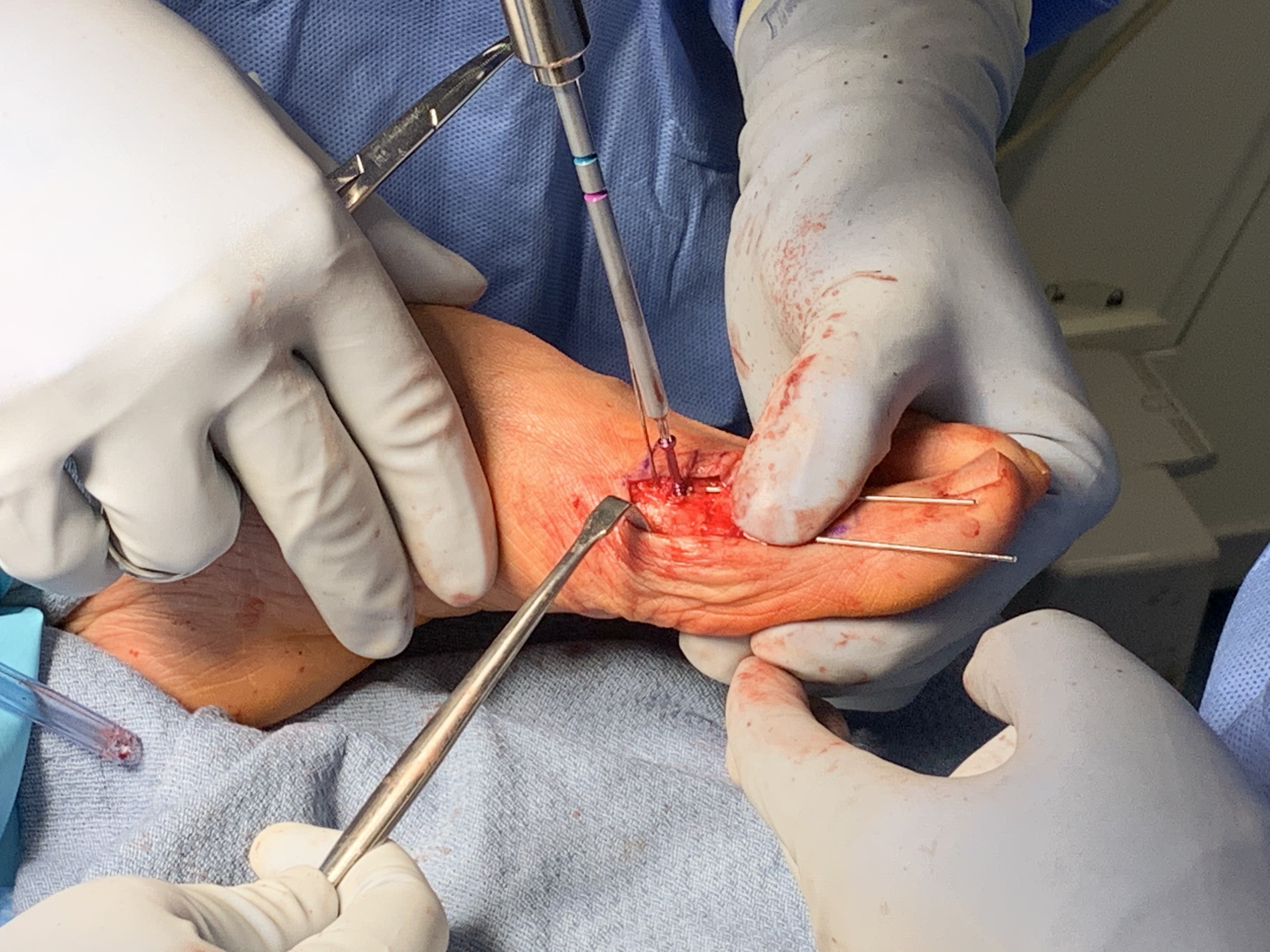 Cannulated screw fixation placed across osteotomy site creating the center portion of the goalpost