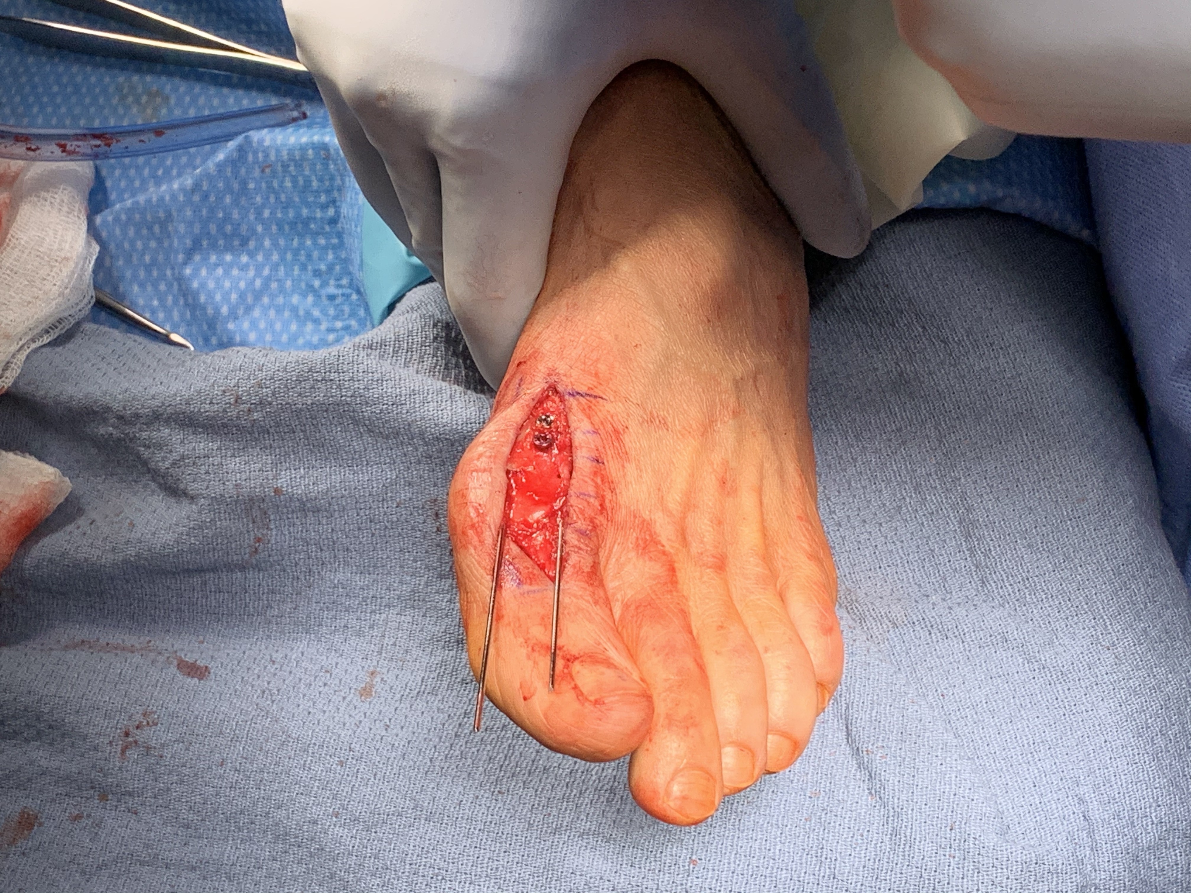 Two cannulated screws placed across osteotomy site avoiding the provisional k wires used for temporary fixation of the osteotomy