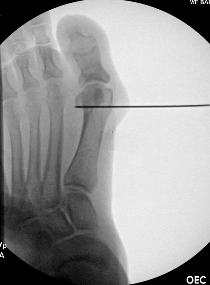 K wire driven from medial to lateral perpendicular to the shaft of the first metatarsal