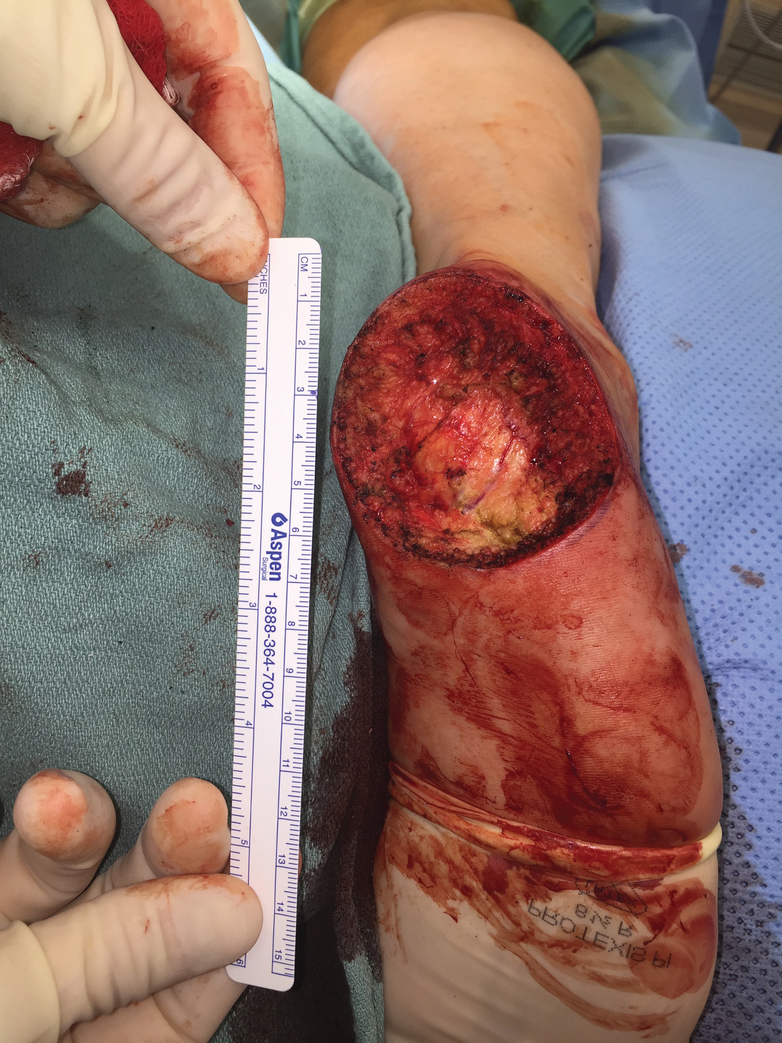 Figure 2. Intraoperative: residual defect following resection of melanoma..