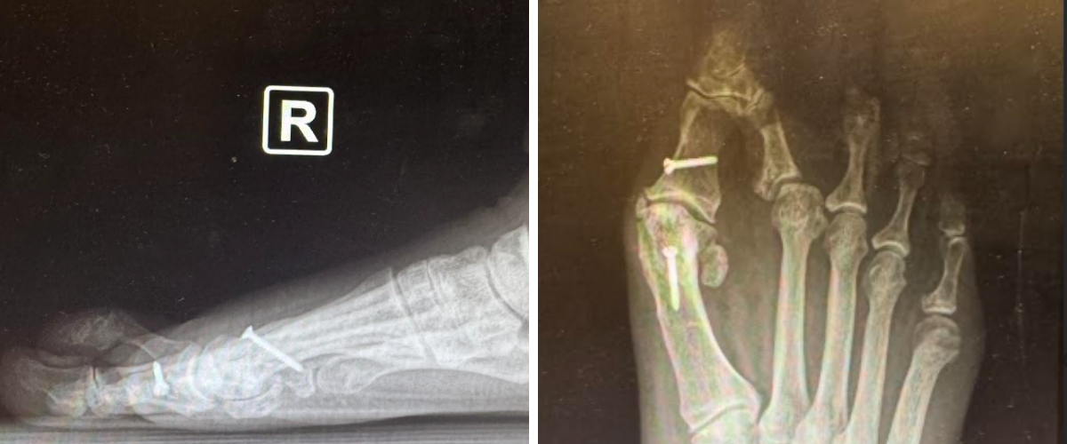 Figure 4. Anteroposterior and lateral X-rays displaying a recurrent hallux valgus and a crossover second toe deformity.