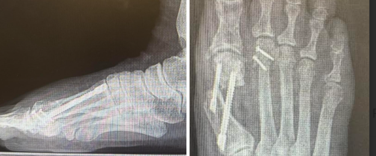 Figure 5. Post-operative X-rays with improved first and second toe positions by utilizing an oblique metatarsal osteotomy and revision bunion osteotomy.