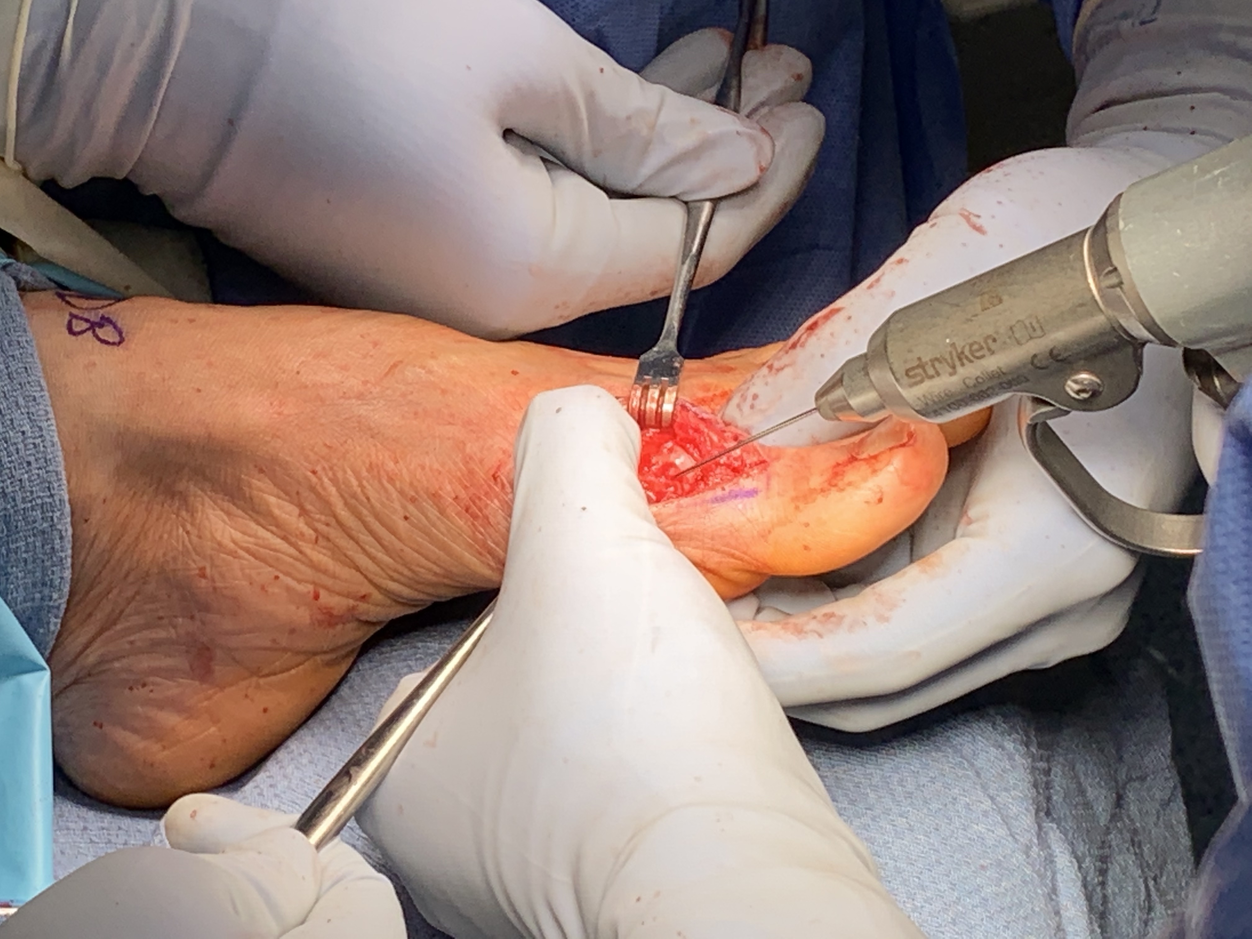 0.045 kirschner wire is introduced through the dorsal medial cartilage of the metatarsal head