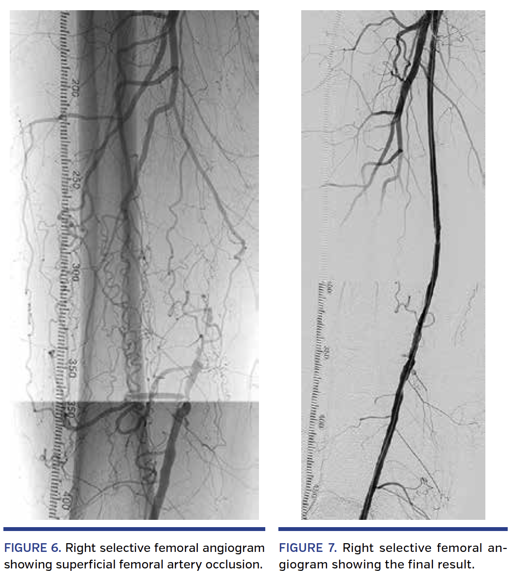 Fig 6 7 Right selective femoral angiogram.png