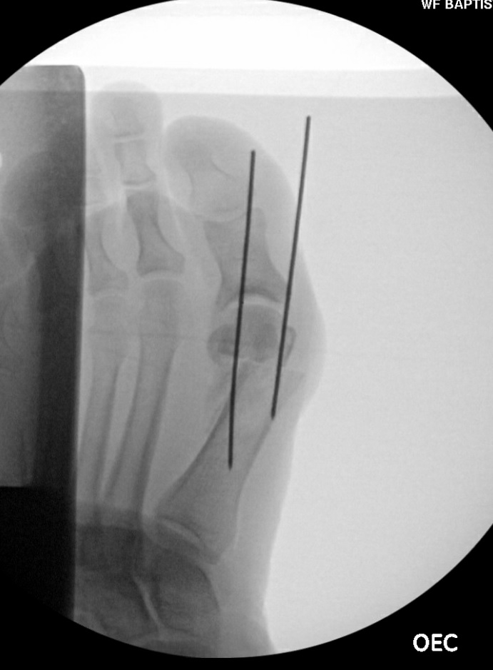 Both medial and lateral K wires placed parallel in first metatarsal across the osteotomy site with central space for permanent fixation