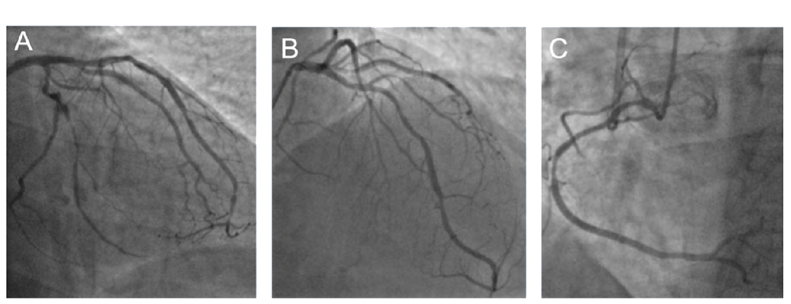 Figure 1. Baseline coronary angiography. (A) 50-60% disease can be seen in the proximal-mid LCx and no significant disease in OM1. Moderate disease is shown in the (B) LAD and (C) RCA.
