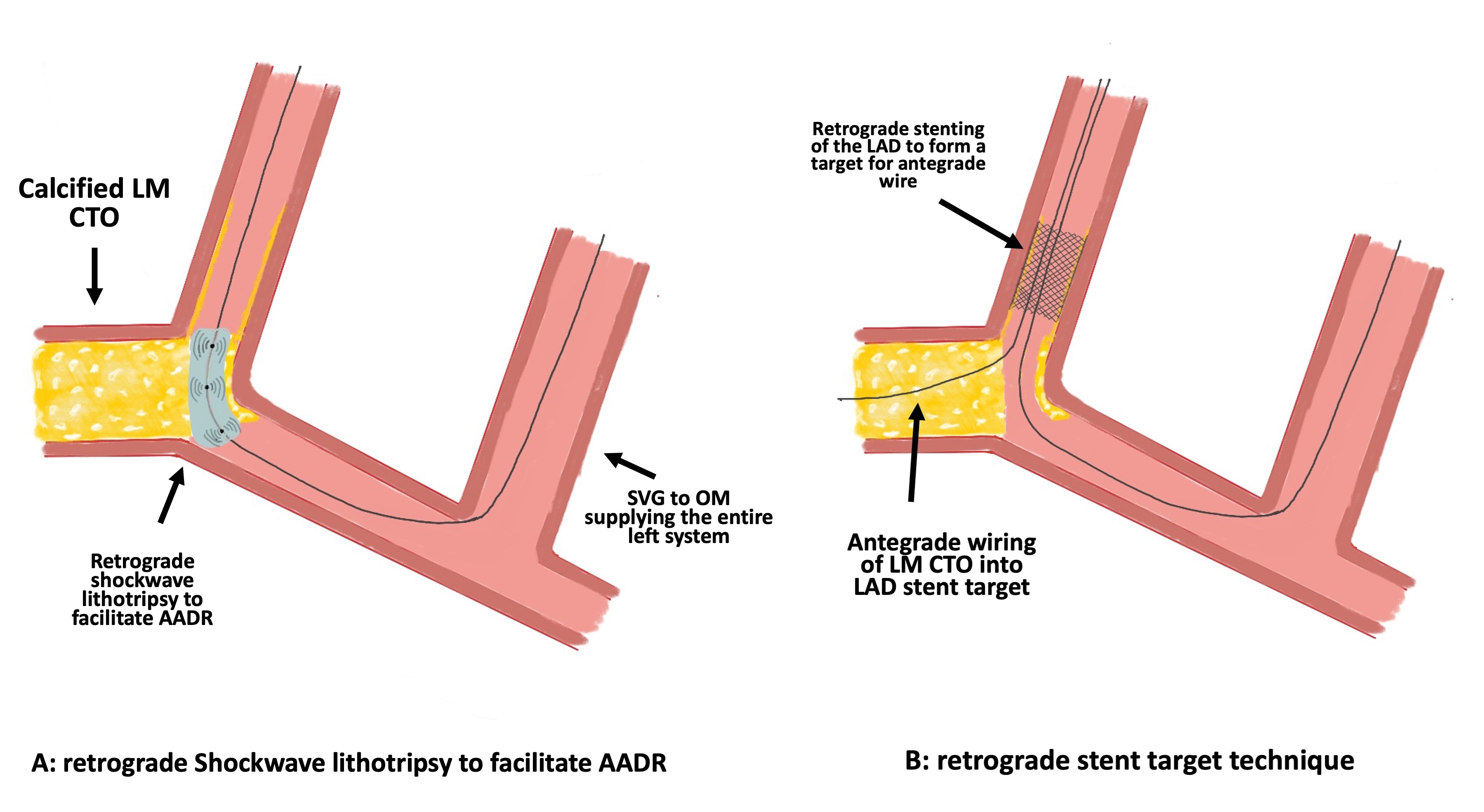 Figure 2. Retrograde lithotripsy