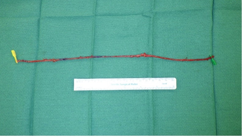 Figure 2. The harvested great saphenous vein. A length of 30 cm is taken in order to create a loop. Branches are carefully ligated to avoid stenosis. Before suturing, saline solution is injected to dilate the great saphenous vein. Areas likely to be stenosed are dissected from the adventitia.