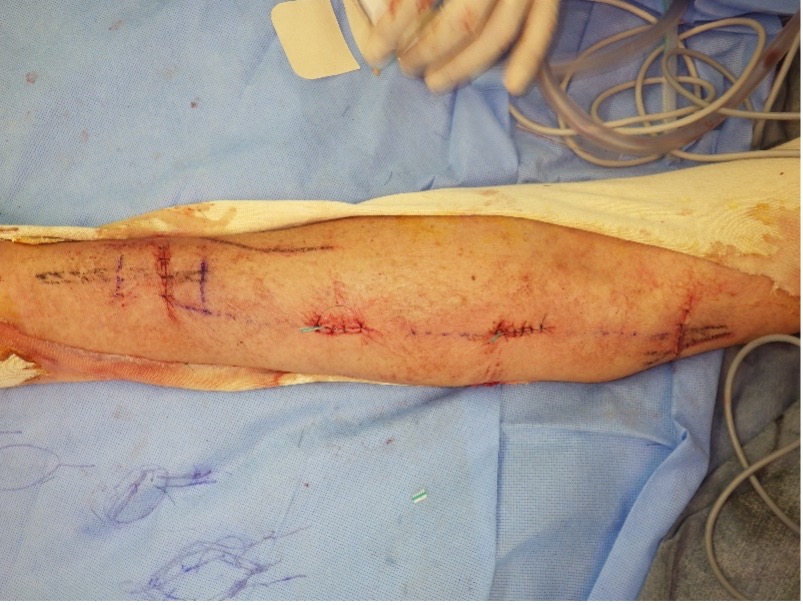 Figure 4. Right forearm at the end of the anastomosis. A subcutaneous tunnel is created to pass the great saphenous vein, carefully ensuring that the harvested saphenous vein is not twisted.
