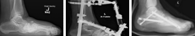 Figure 1. Charcot foot in a 62-year-old man. (A) Preoperative imaging. (B) Multiplayer external fixation applied. (C) Post–subtalar, calcaneo-cuboid, talonavicular and tarsometatarsal joints arthrodesis without complications. This case illustrates staged reconstruction with prompt transition to definitive fixation once soft tissues permitted.&nbsp;&nbsp;