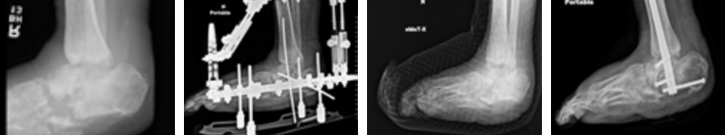 Figure 2. Midfoot and hindfoot Charcot in a 78-year-old man. (A) Preoperative imaging. (B) Ring external fixation applied. (C) Ex-fix removal for non-orthopedic indication, transitioned to total contact cast. (D) Post–ankle and subtalar joint arthrodesis with intramedullary nail without complication. This case highlights the variability in timing of definitive fixation in clinical practice.&nbsp;