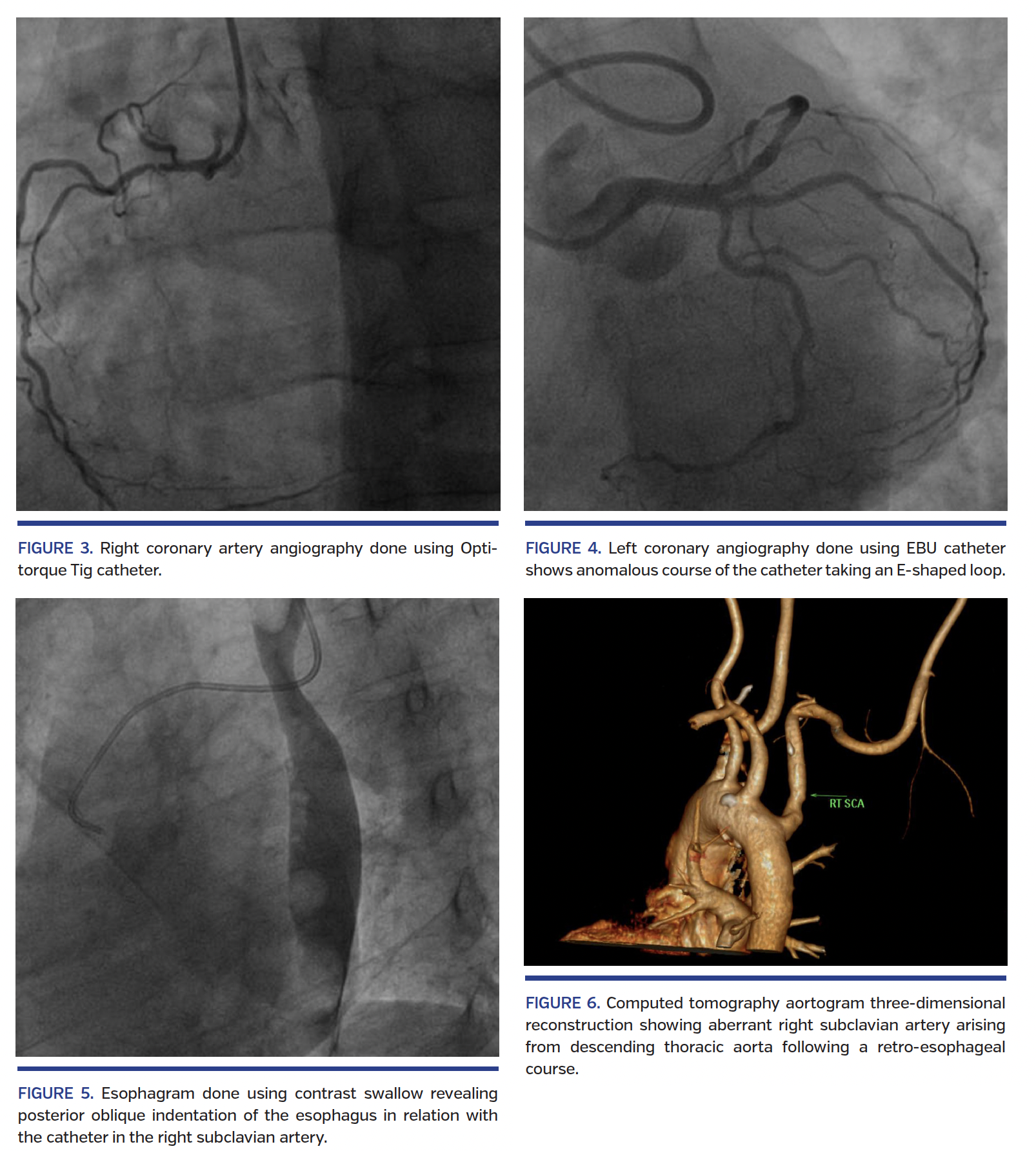 Incidental Detection of Arteria Lusoria During Transradial Coronary Intervention