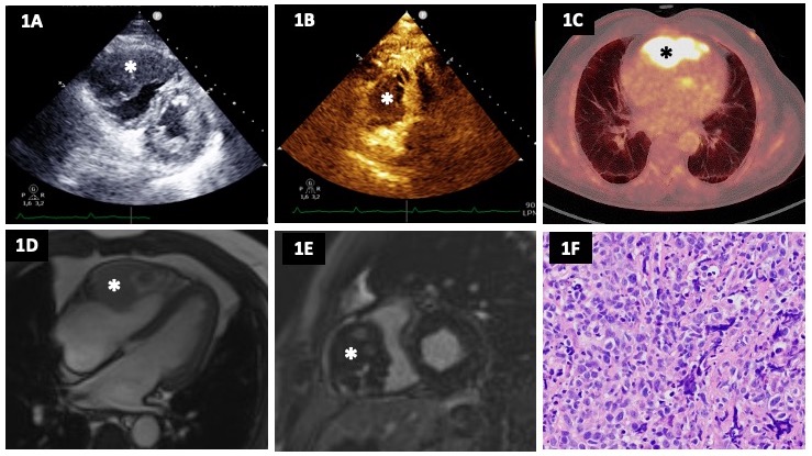 Figure. Multimodal imaging of the cardiac lymphoma  