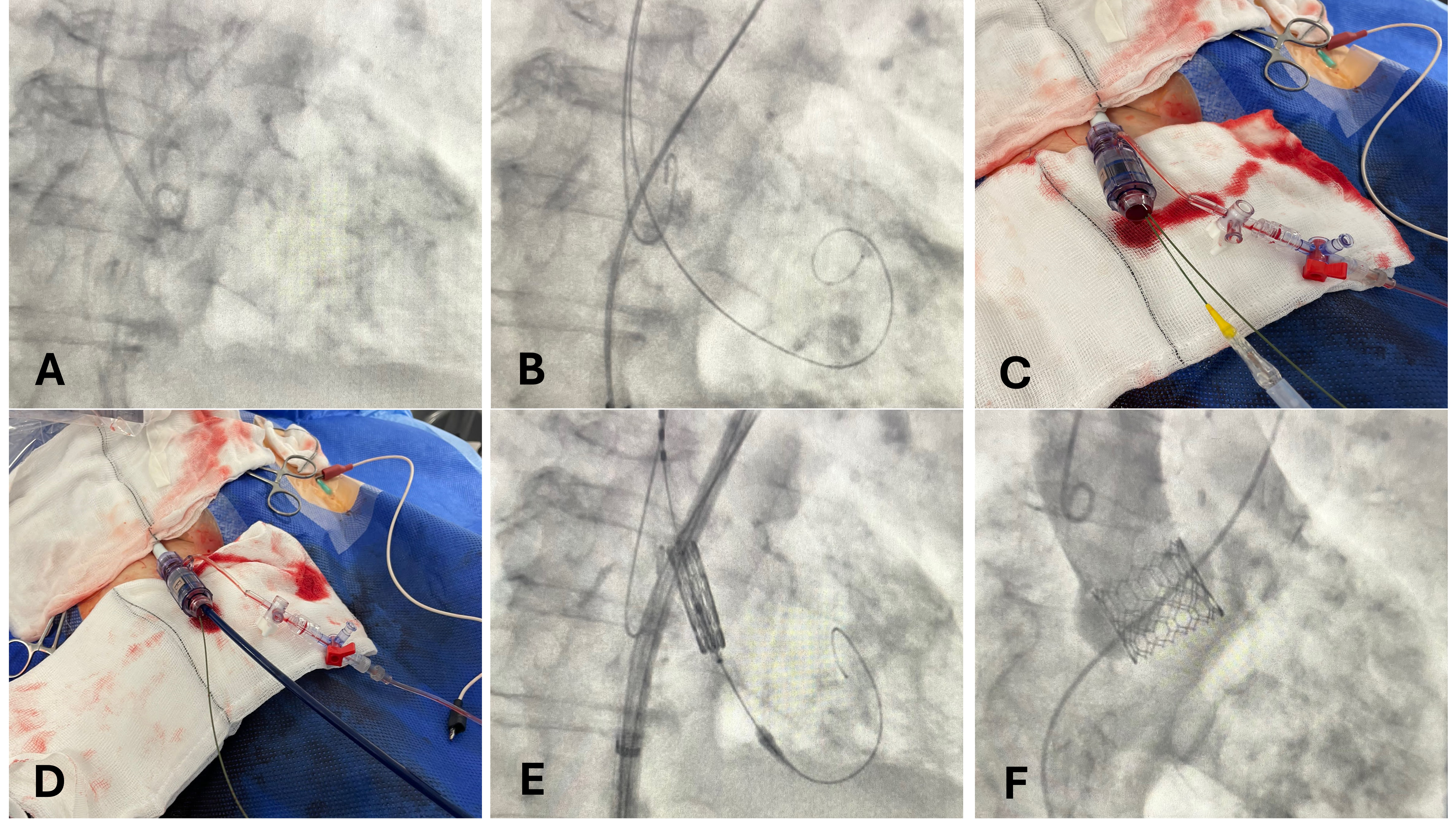 Figure. Single access transcatheter aortic valve implantation 