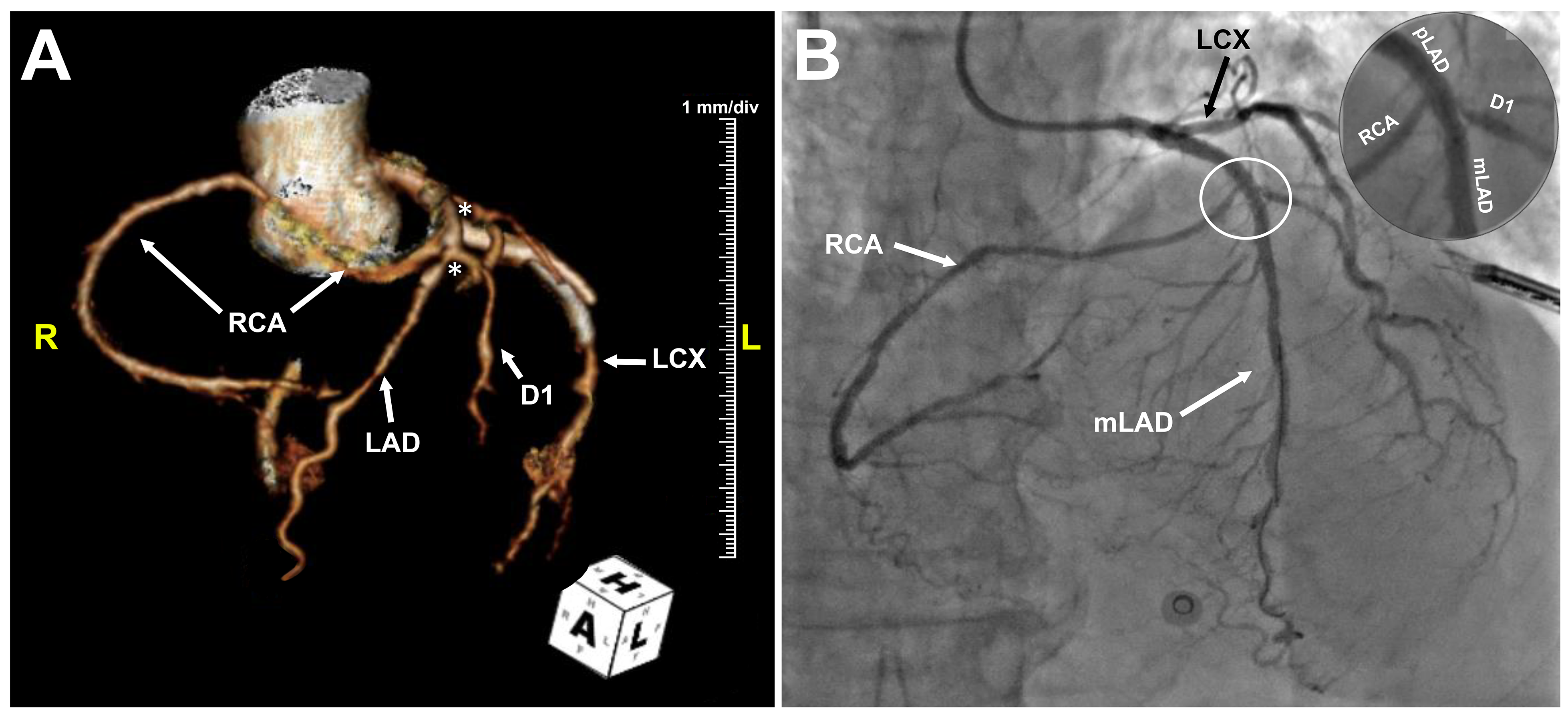 Figure. (A) A 3-dimensional computed tomographic reconstruction