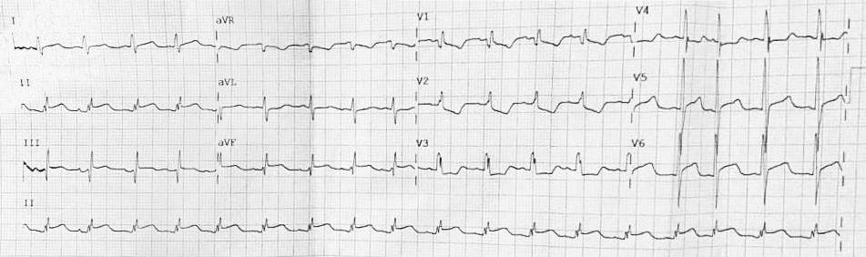 Figure 1. Electrocardiogram