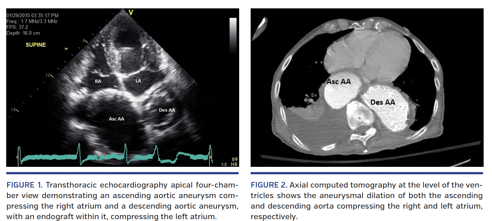Bi-Atrial Compression Due to Ascending and Descending Aortic Aneurysms