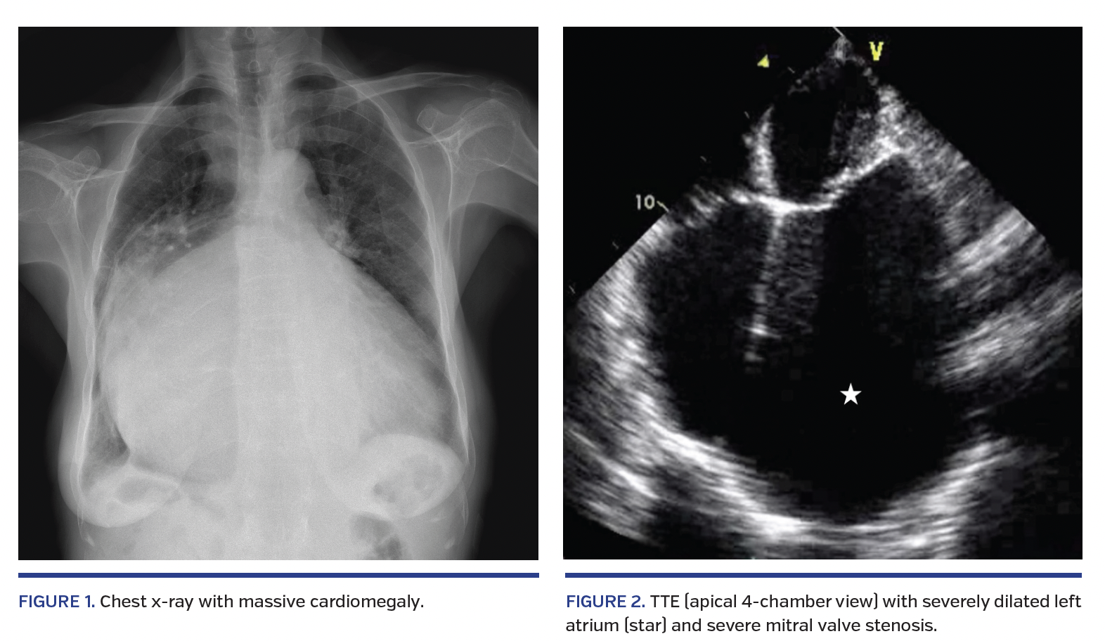 Chest x-ray with massive cardiomegaly