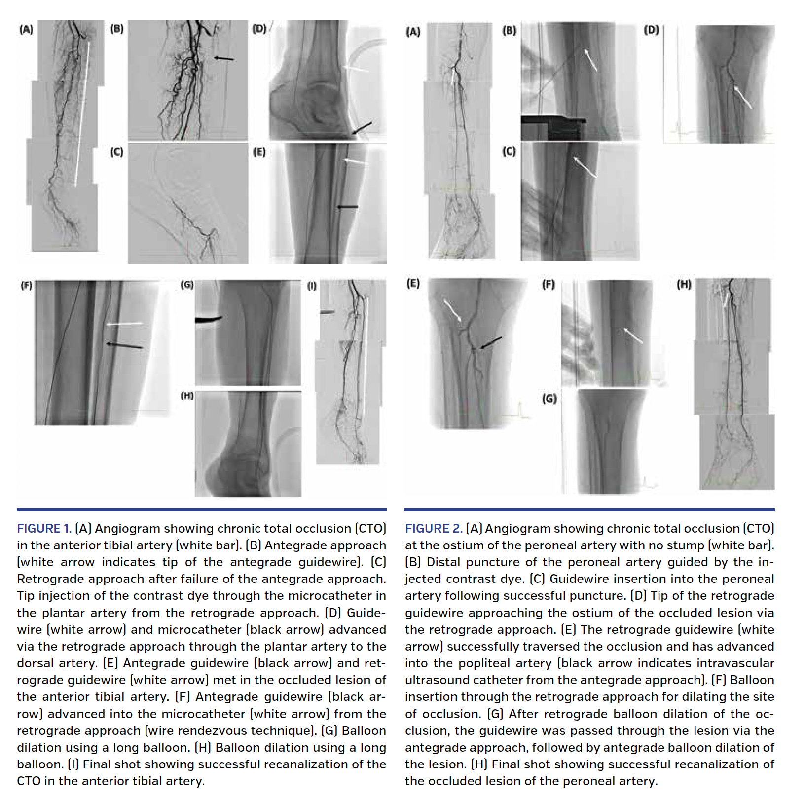 Long-Term Result s of a Retrograde Approach