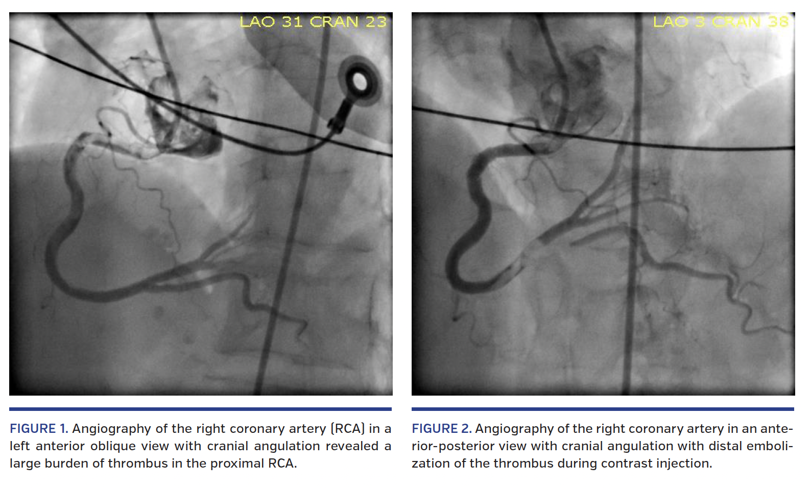  Angiography of the RCA in a left anterior oblique 