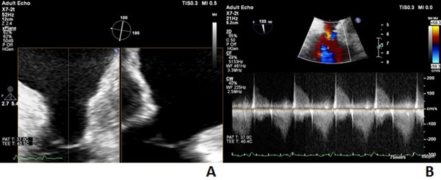 Figure 1. Preprocedural transesophageal echocardiogram (case 1).