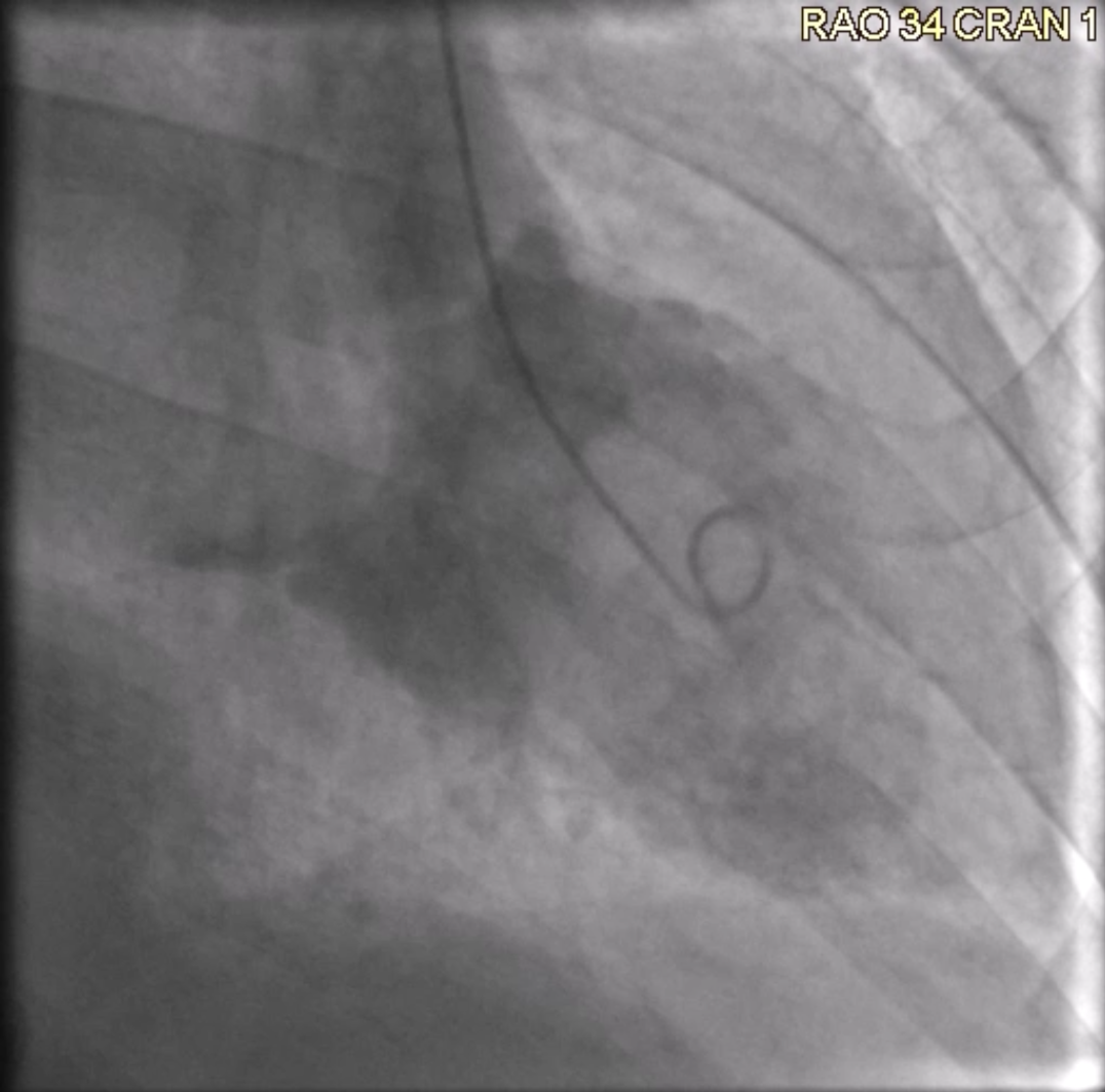Figure 1. Left ventriculogram with mxyoma.