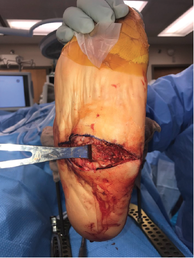 This photo illustrates a typical wound associated with midfoot Charcot neuroarthropathy