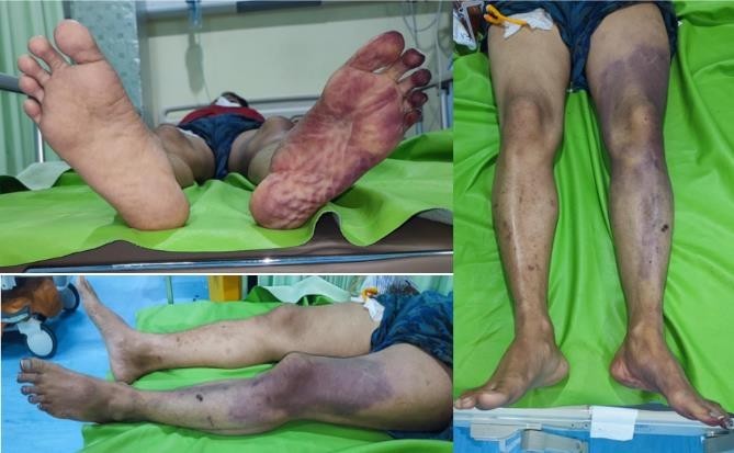 Figure 1. The left lower leg had regional skin darkening at the level of the femoral region, necrotic toes, was cold to the touch, had a motor strength of 3/5, and there was no pulsation on the posterior tibial artery, popliteal artery, and femoral artery.