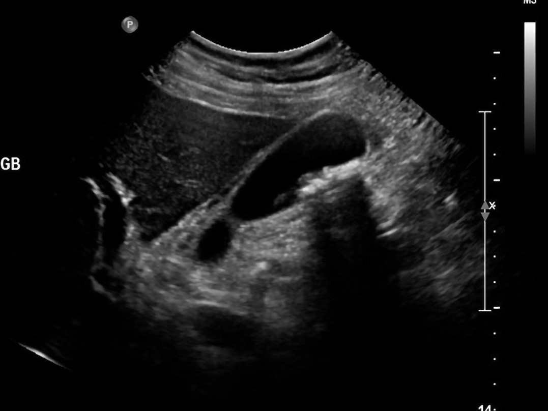La colecistitis aguda representa del 3 al 4 % del total de ingresos hospitalarios entre los pacientes con dolor abdominal. 