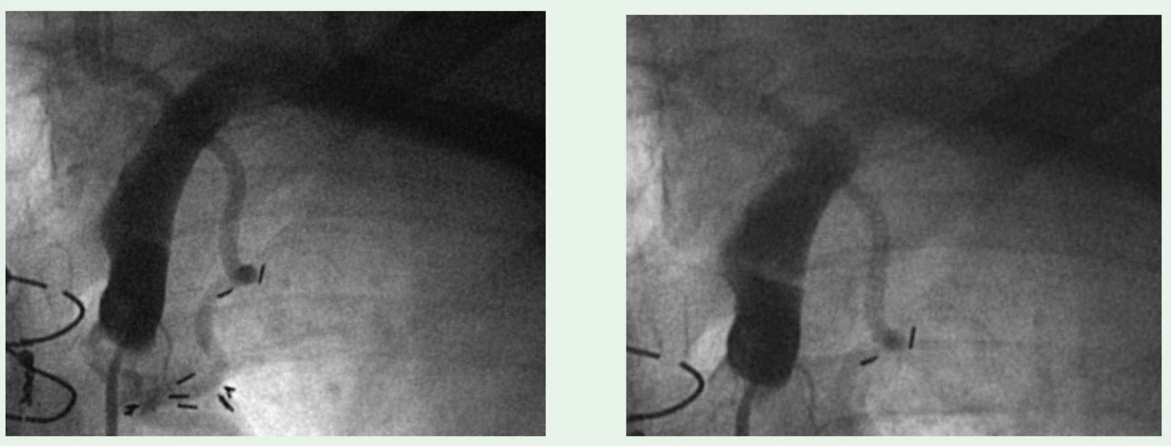 Figure 1. Exacerbation of proximal kink (left: inspiration, right: expiration).