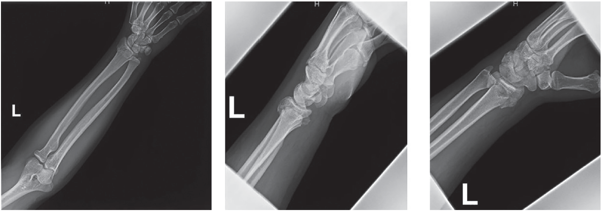Figure 1 Siotos Distal Radius 