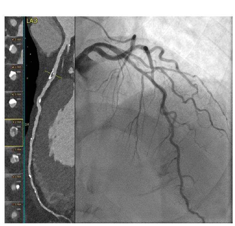 Figure 1. CCTA and invasive catheterization of the LAD.