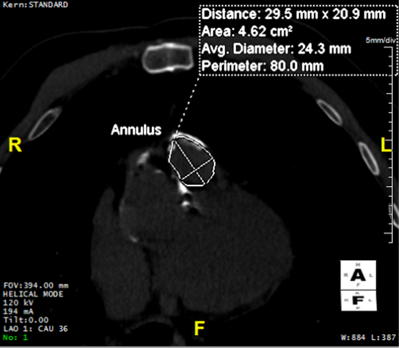 (Case 2) Figure 1. CT Image pre-valve&nbsp;replacement and pre TEE.