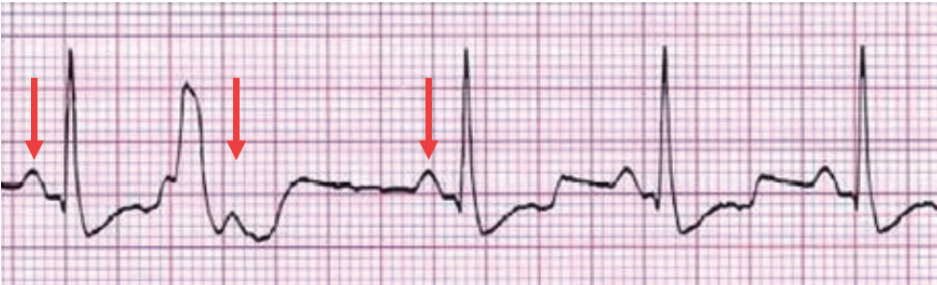 Figure 1. Compensatory pause - visible P waves