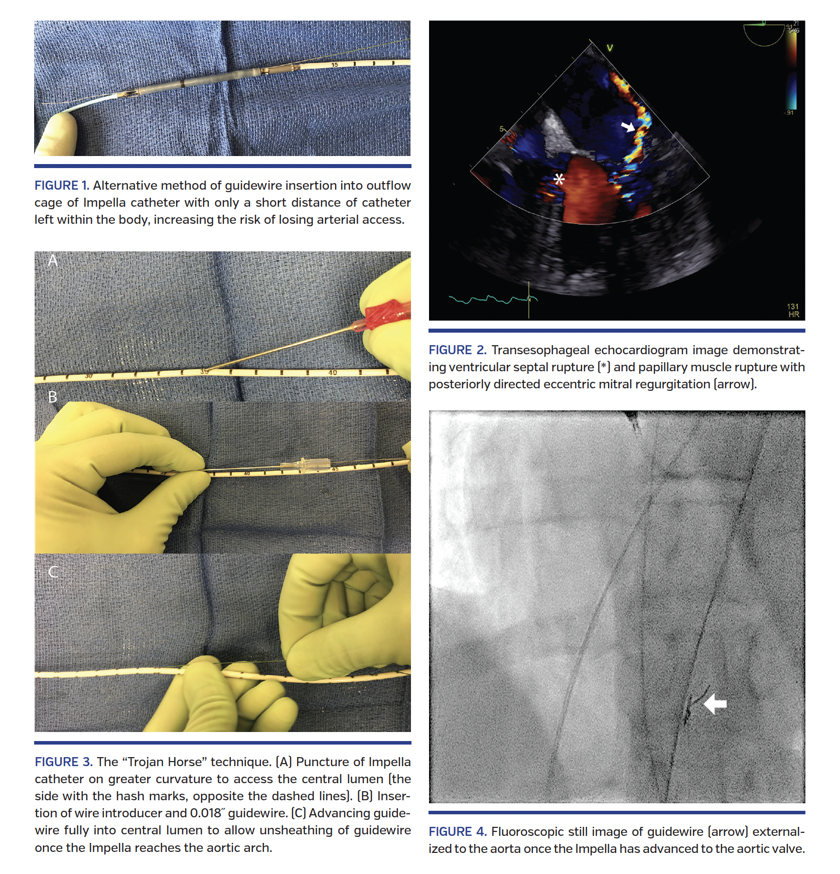 Figure 1. Trojan Horse Impella Exchange.png