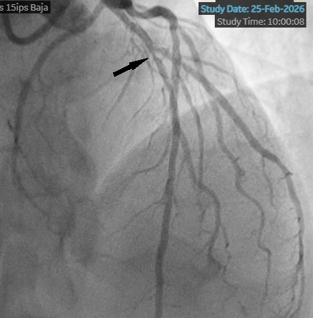 Figure 1. Angiogram depicted an intermediate lesion