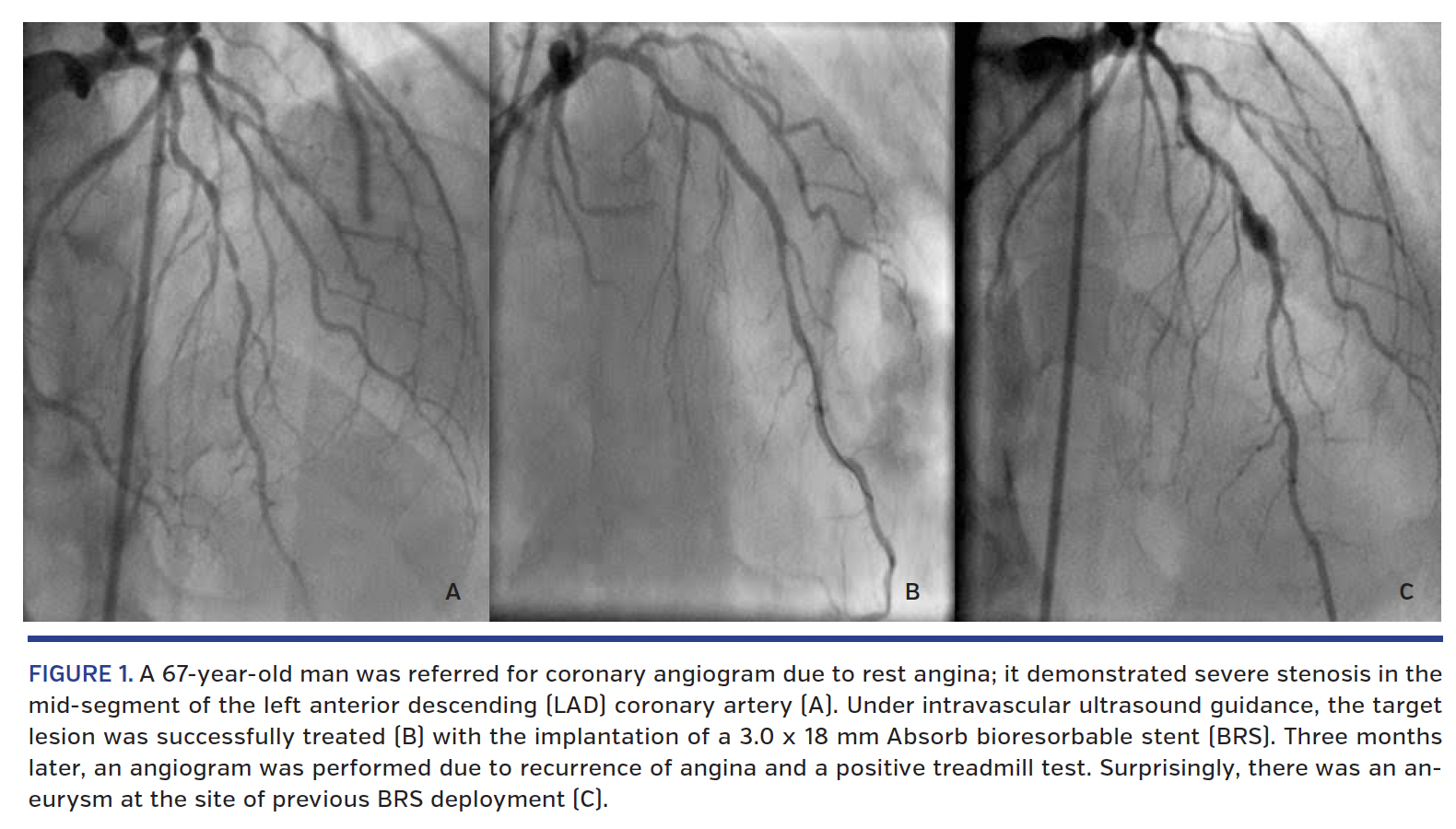 Figure 1. coronary angiogram.png