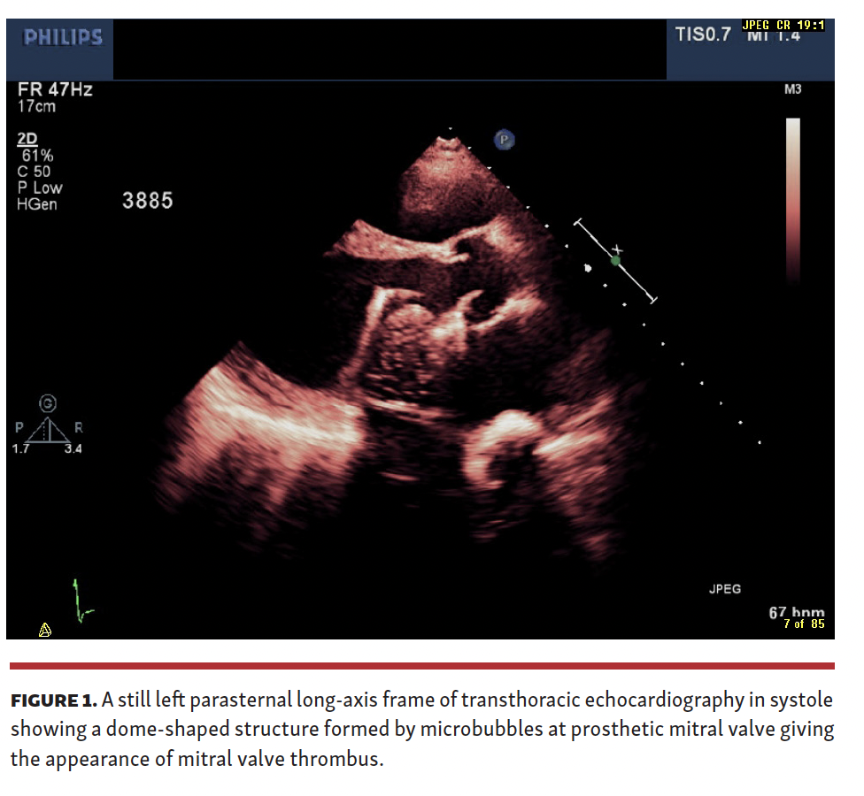 A still left parasternal long-axis frame of transthoracic echocardiography in systole showing a dome-shaped structure formed by microbubbles at prosthetic mitral valve giving the appearance of mitral valve thrombus.