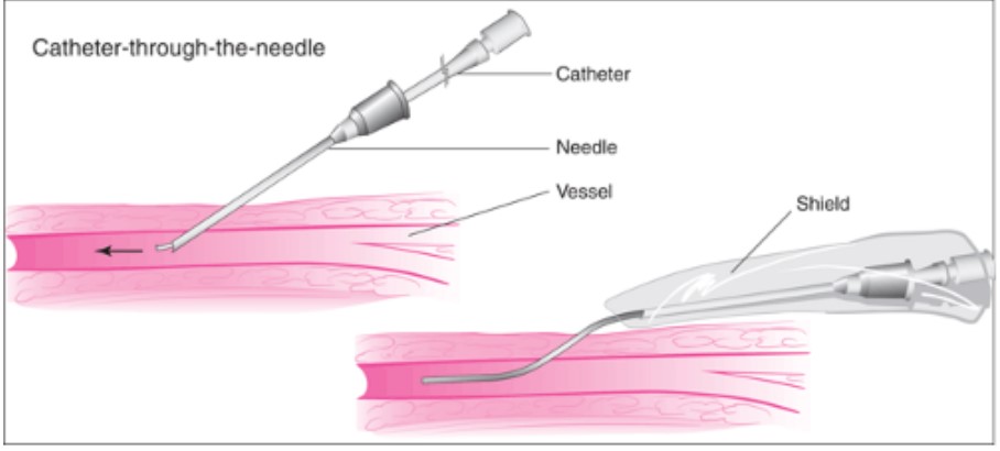 Figure 10: Catheter through the needle (Photo: obgynkey.com) 